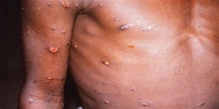 Hospital staff to be prepared in case of a monkeypox outbreak as fear looms