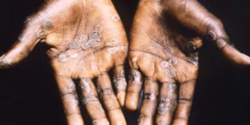 Should Pakistan be frightened about the spread of monkeypox?